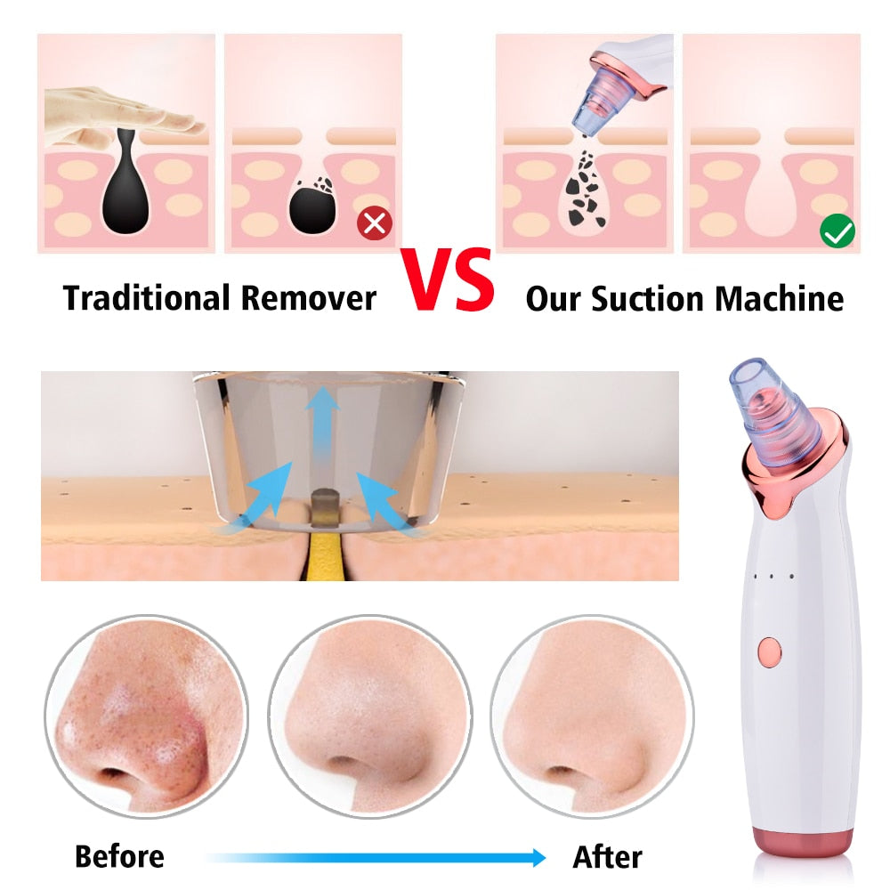 Pore Cleaner Vacuum